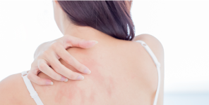 Dermatitis atópica en la adultez